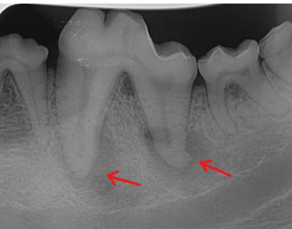 Tulehdusreaktio hampaan juuren kärjissä